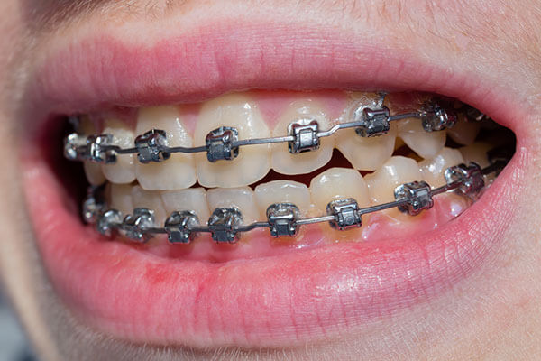 Braces to correct alignment of upper and lower teeth